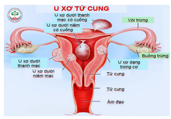 U XƠ TỬ CUNG: NGUYÊN NHÂN, TRIỆU CHỨNG, CHẨN ĐOÁN VÀ PHÒNG NGỪA